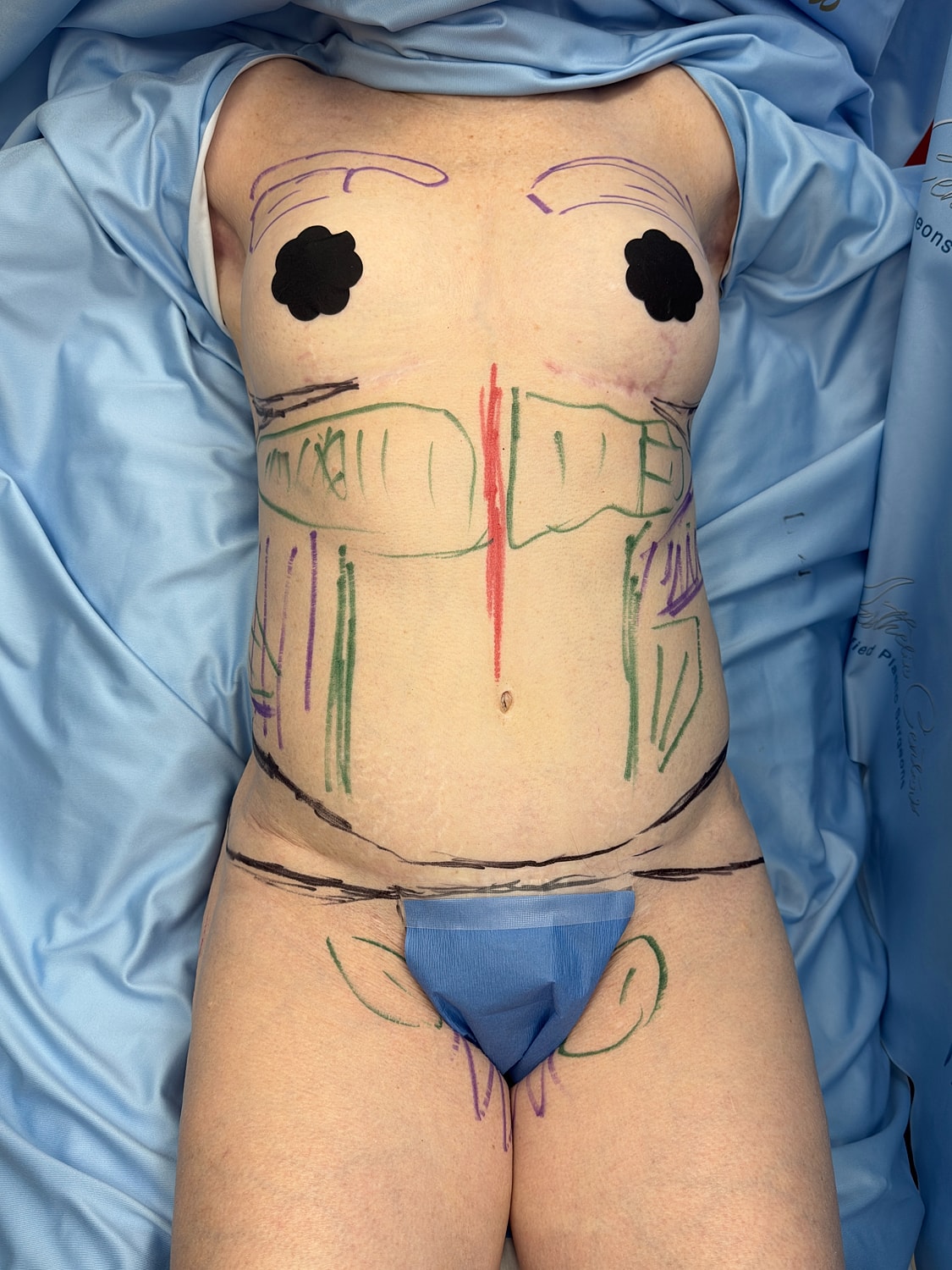 Body markings on patient for surgical preparation.
