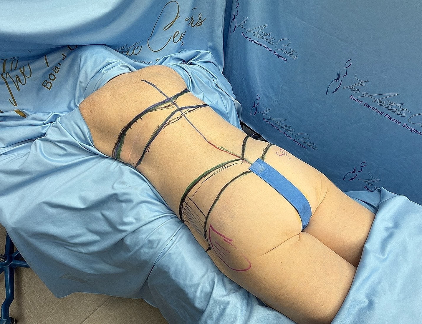 Patient prepared for body contouring procedure.
