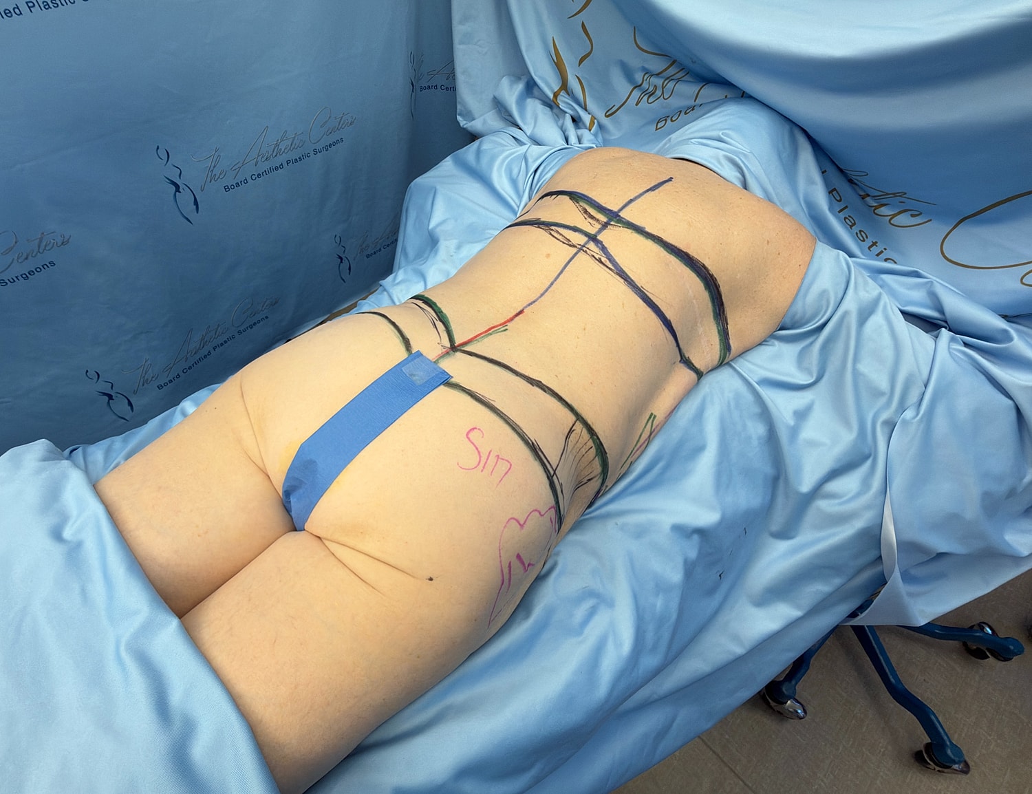 Patient preparation for body contouring surgery.