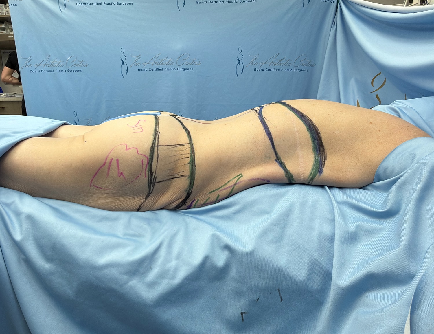 Body marking in preparation for surgery.