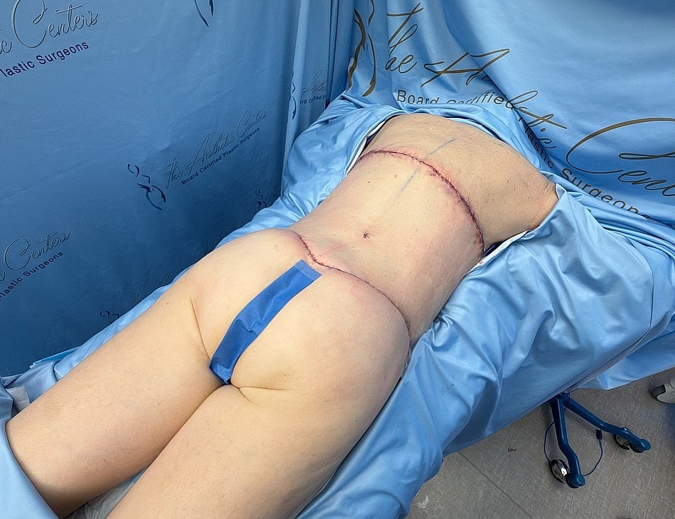 Patient lying on table post-surgery.