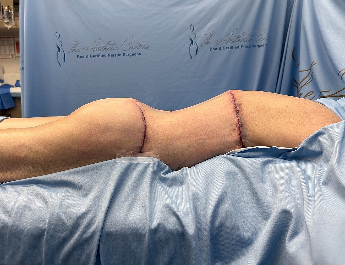 Post-surgery view of body contoured with scars.