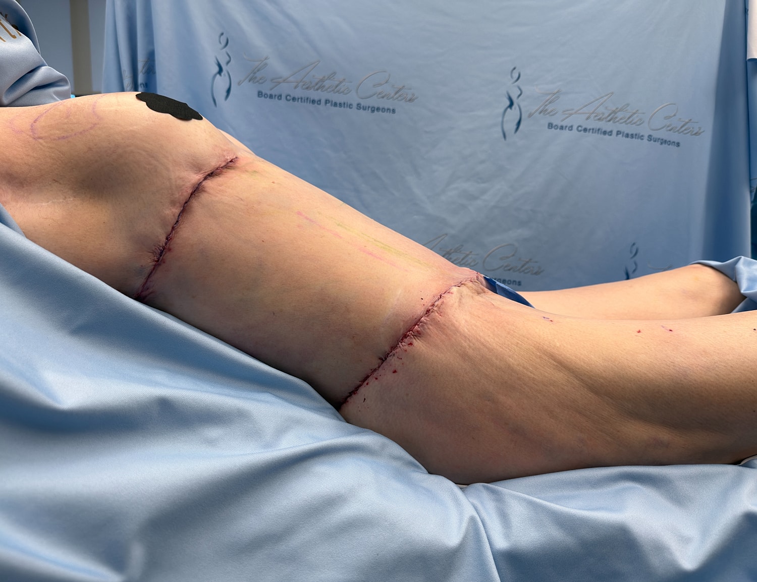 Post-surgery view of stitched leg.