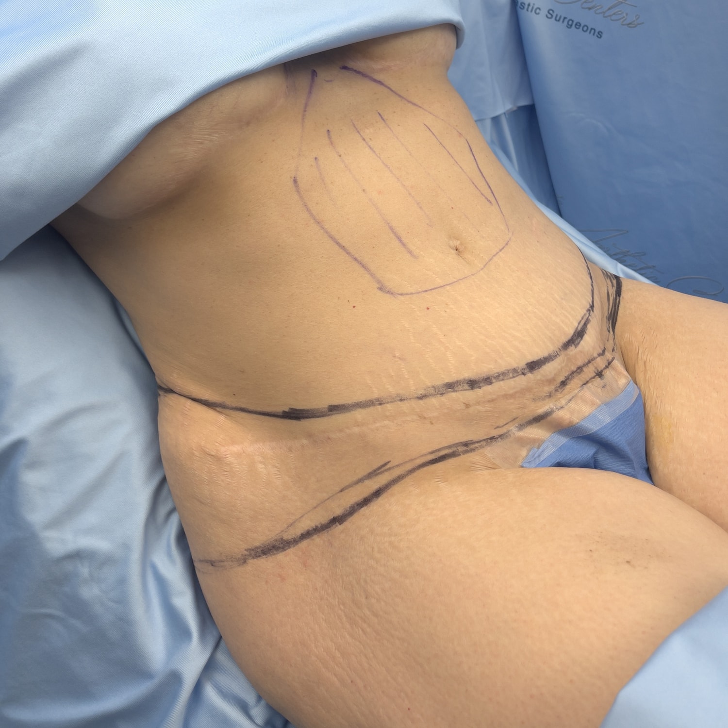 Surgical markings on abdomen before procedure.