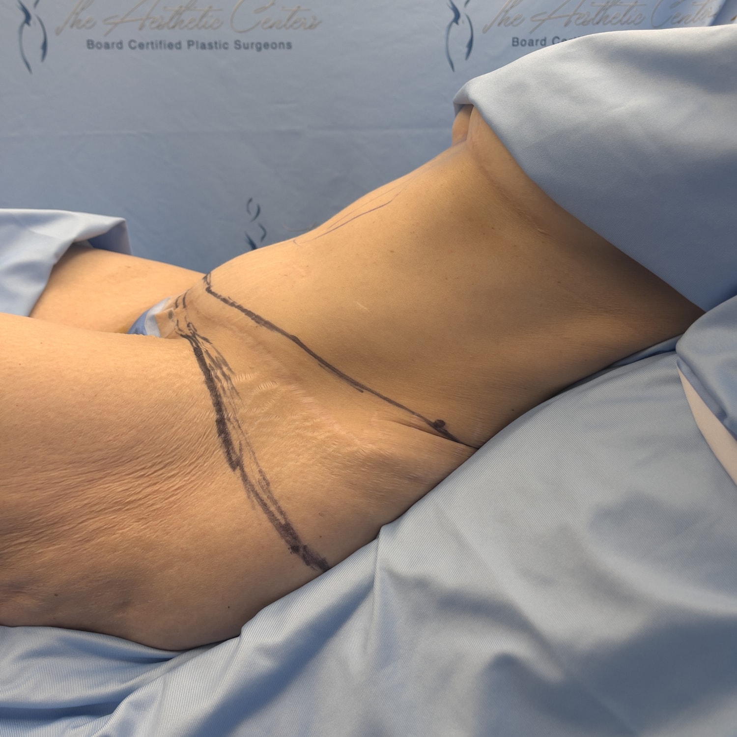 Patient's side view with surgical markings.