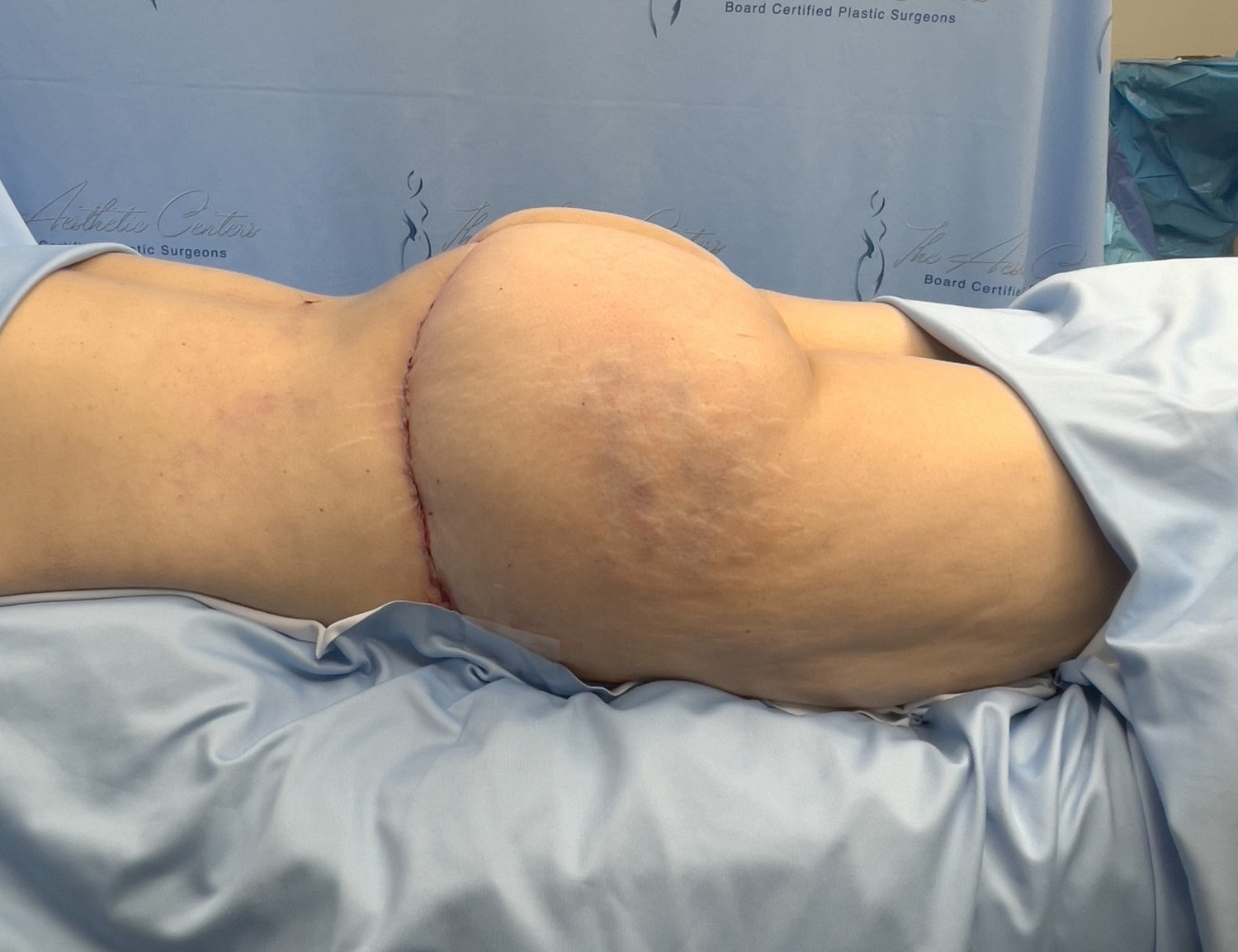 Post-operative view of a surgical procedure.