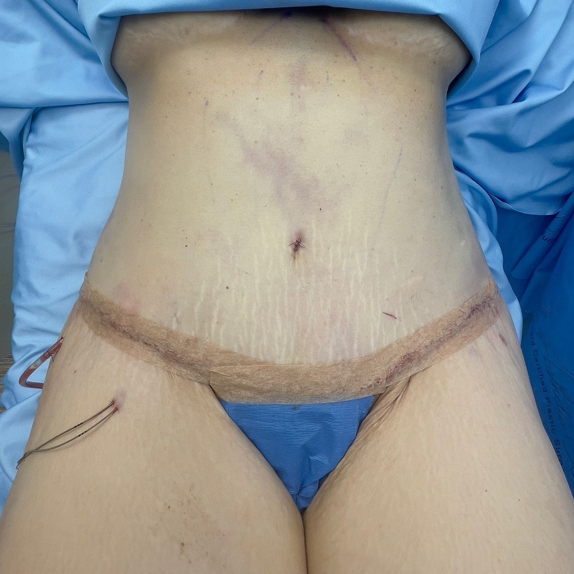 Post-surgical abdomen with visible incisions and stitches.