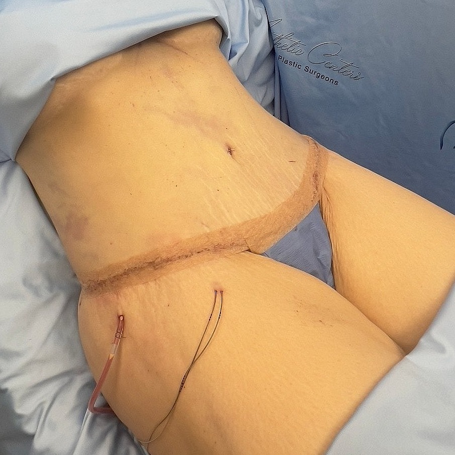 Surgical abdomen with healing incision and drainage.