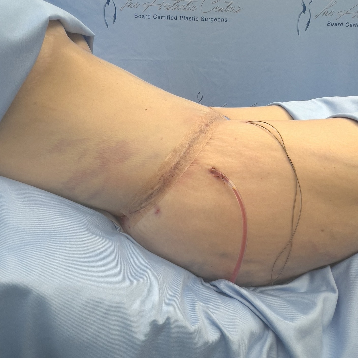 Surgical site with drainage tubes and sutures visible.
