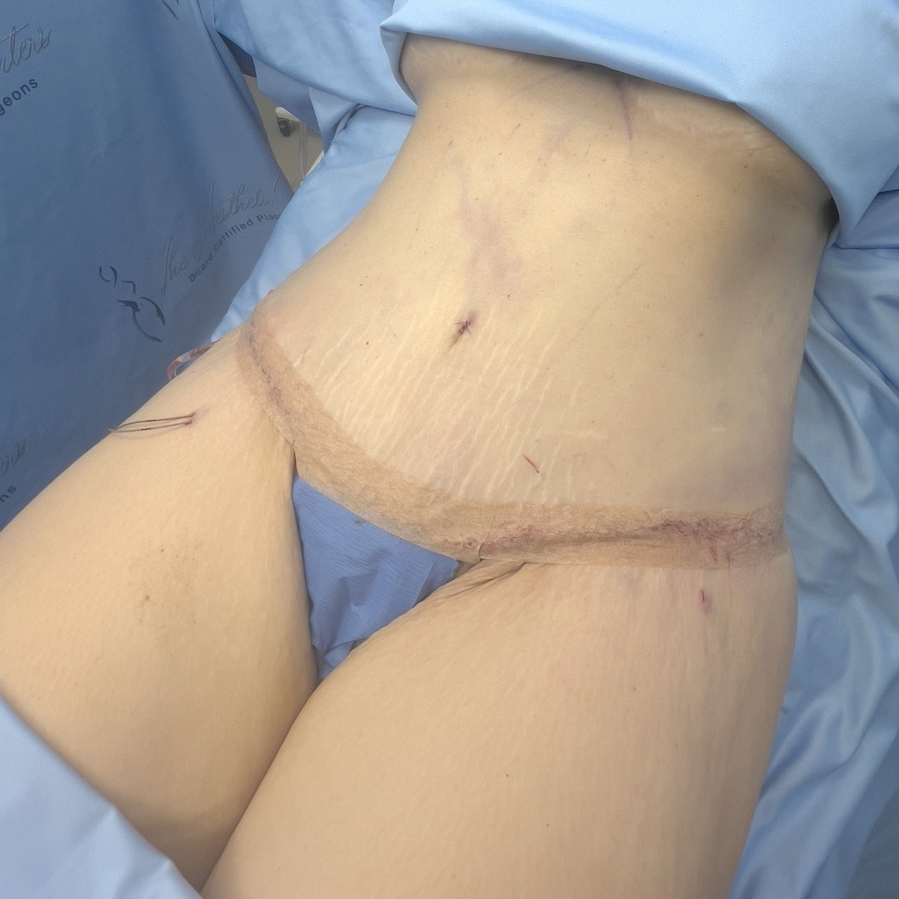 Post-surgery abdominal area with stitches visible.