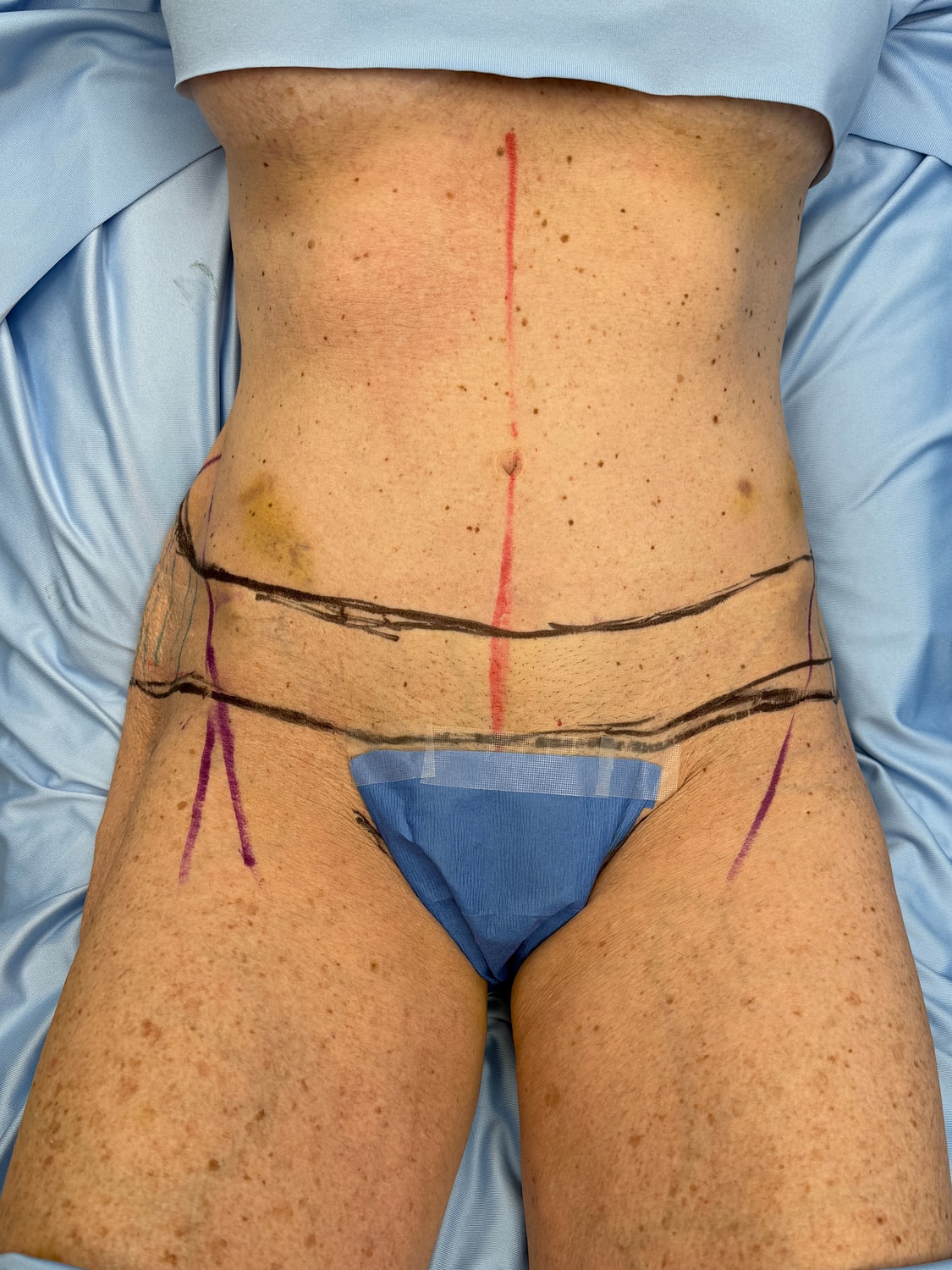 Body preparation for medical procedure with markings.