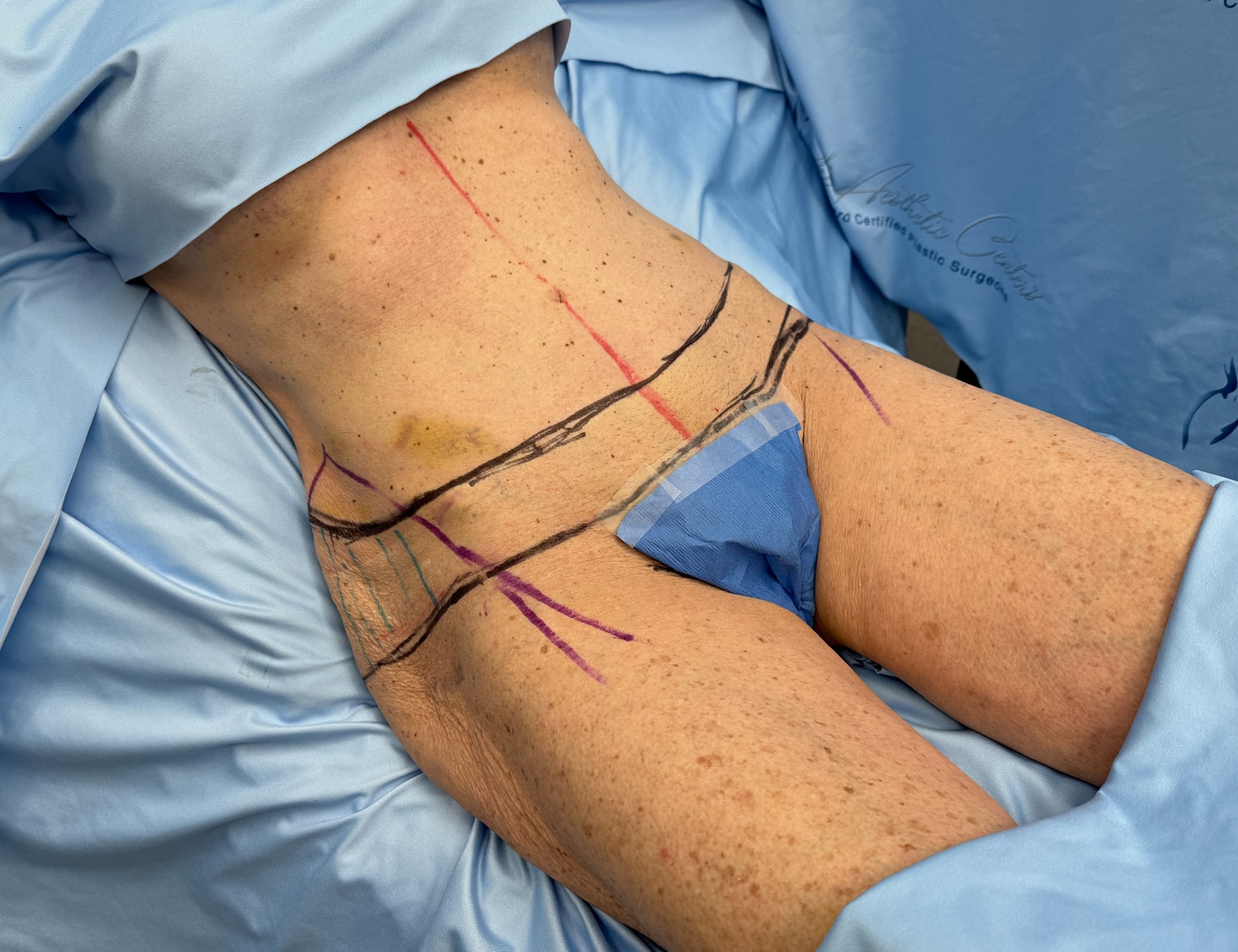 Surgical markings on patient's abdomen and thighs.