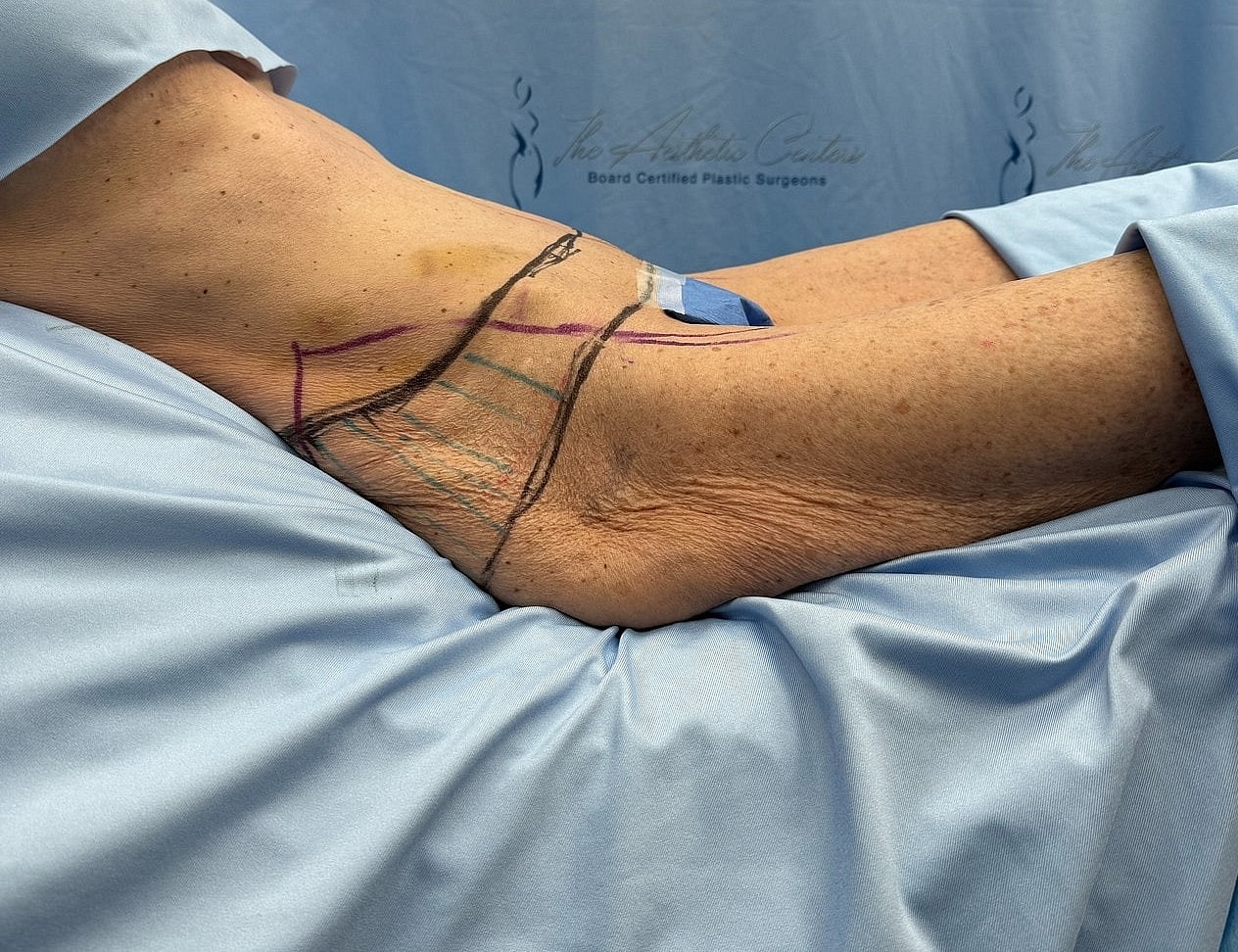 Patient's arm prepared for surgical procedure.