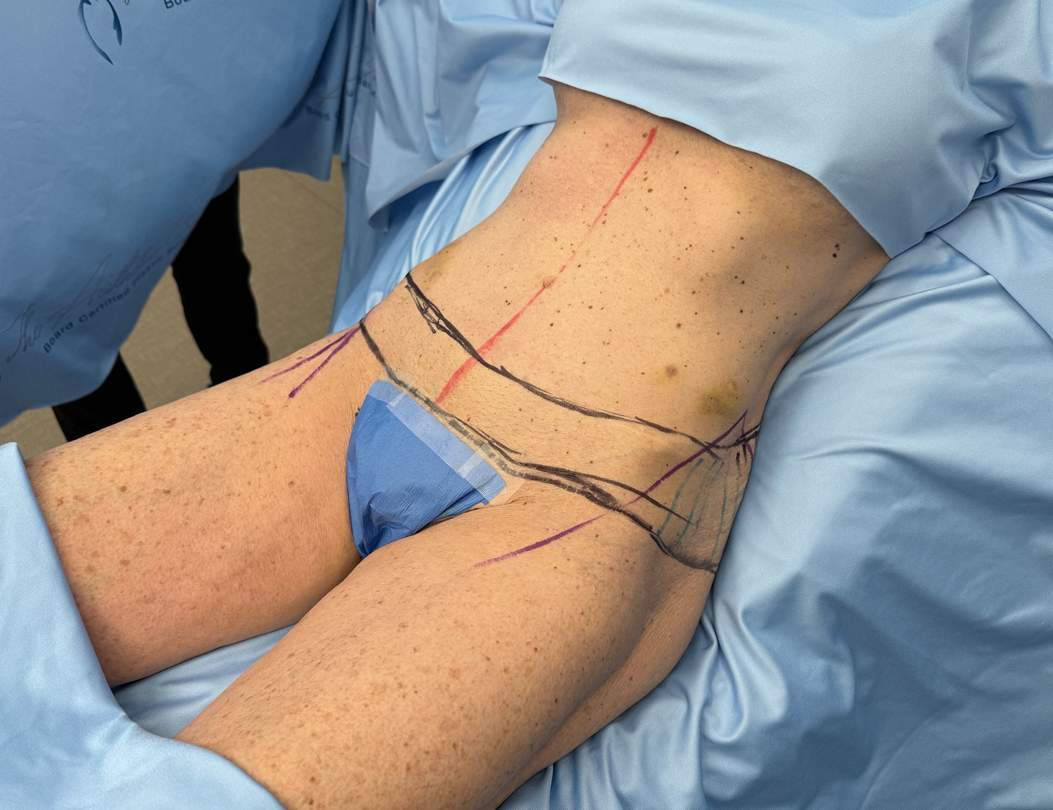 Patient preparing for surgical body contouring procedure.