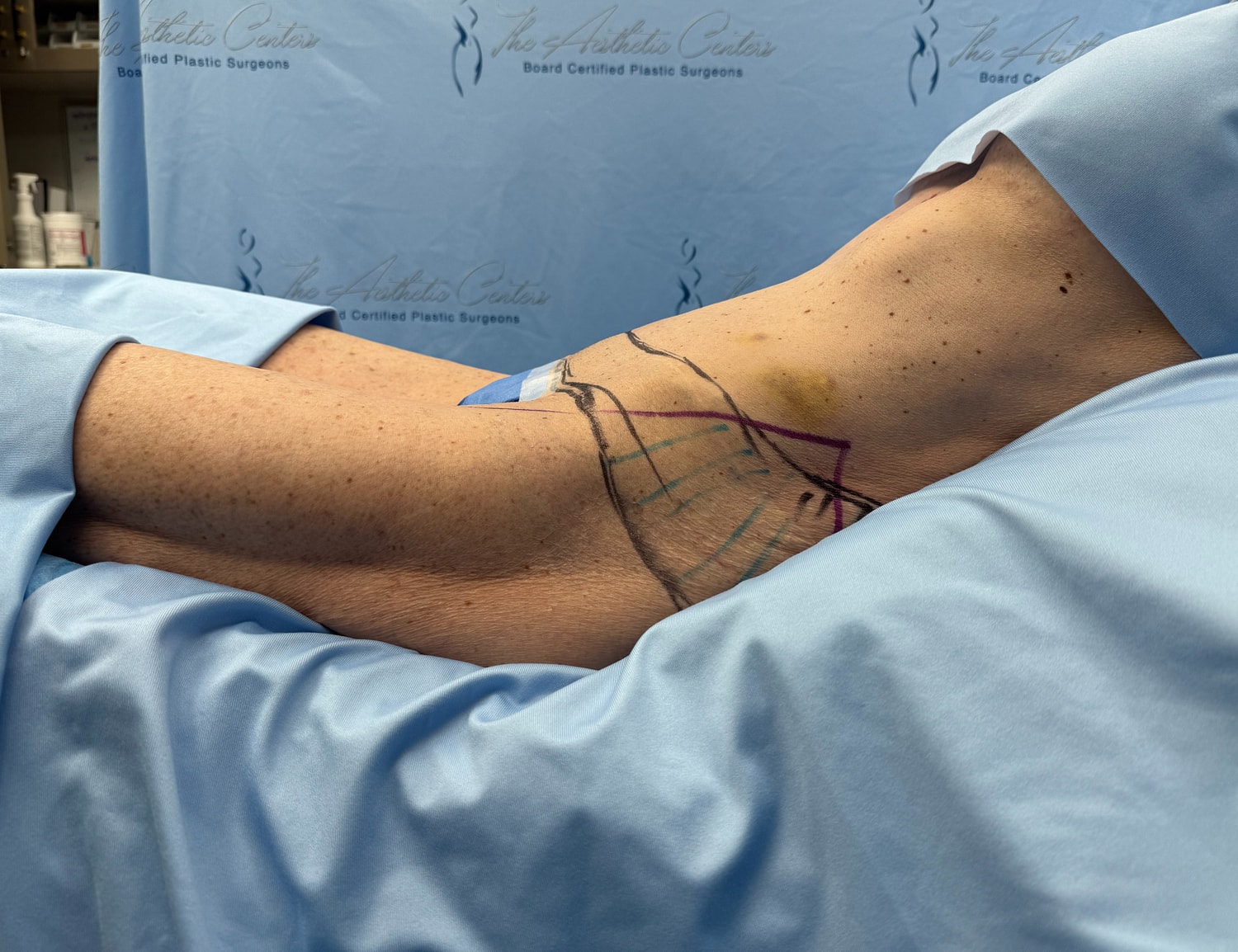 Patient's arm prepared for cosmetic procedure.