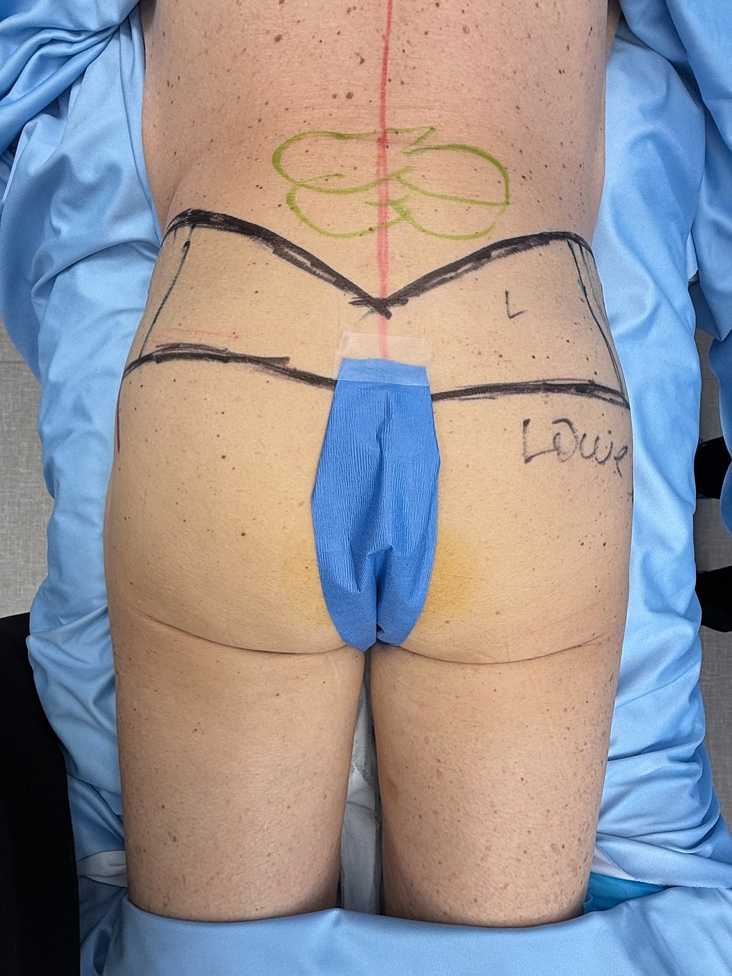 Patient's back marked for medical procedure preparation.