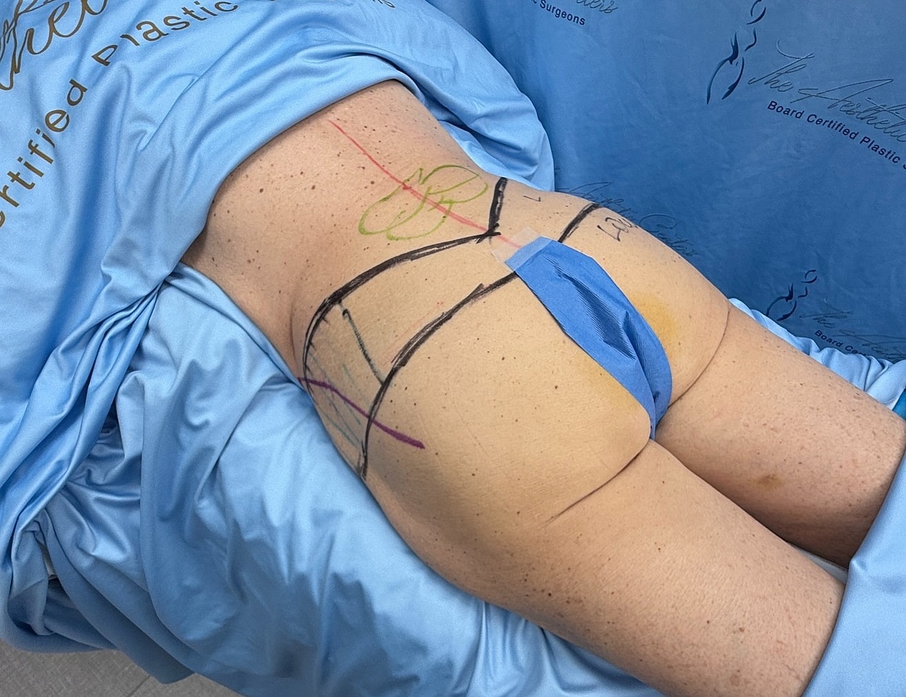 Patient preparation for a cosmetic procedure.