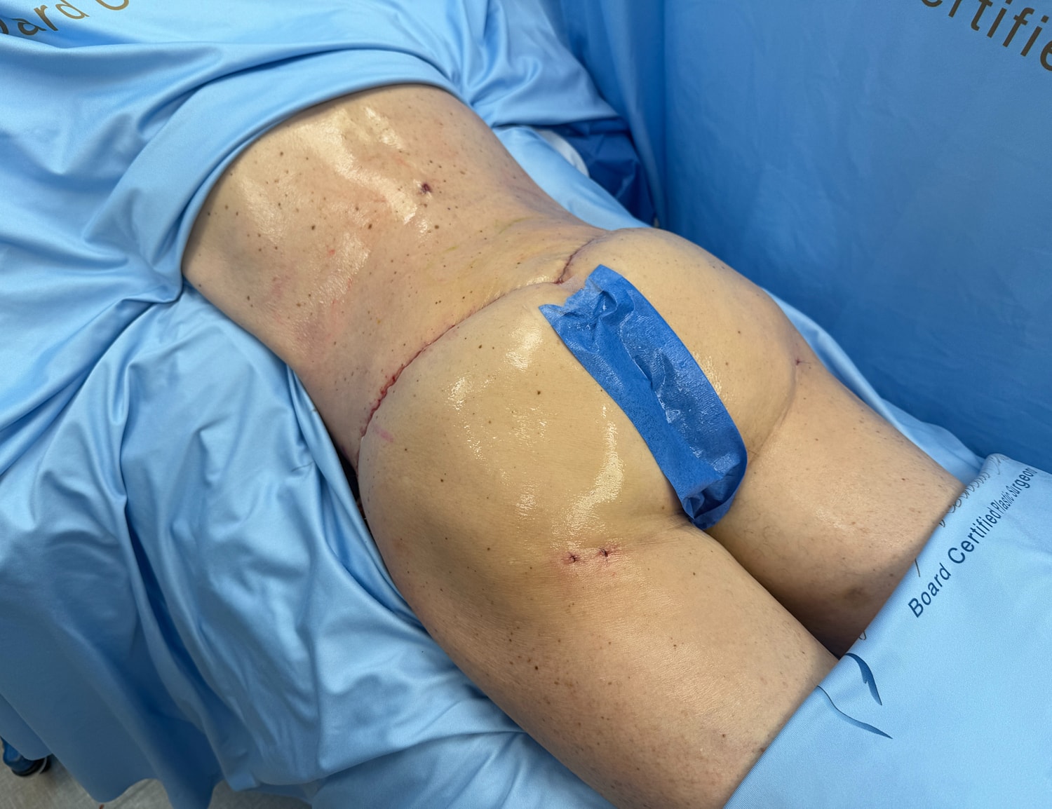 Post-surgery view of a patient’s lower back.