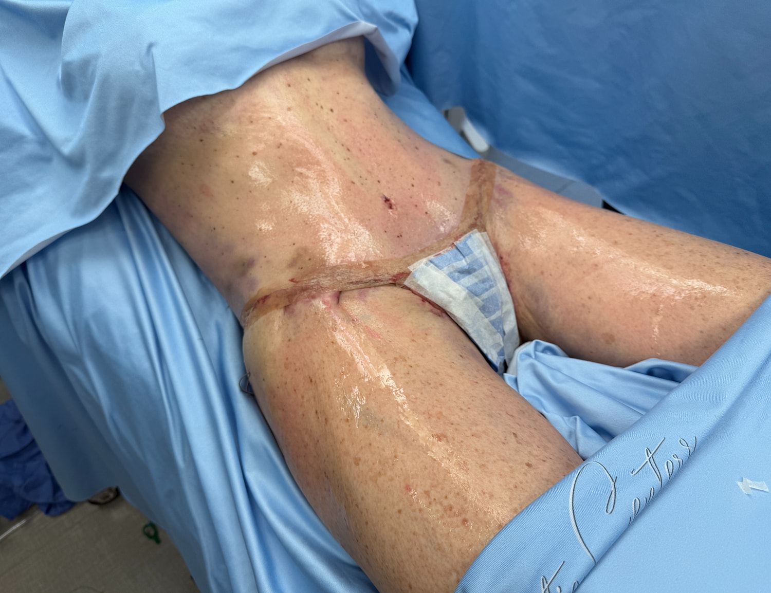 Surgical procedure involving the lower abdomen area.