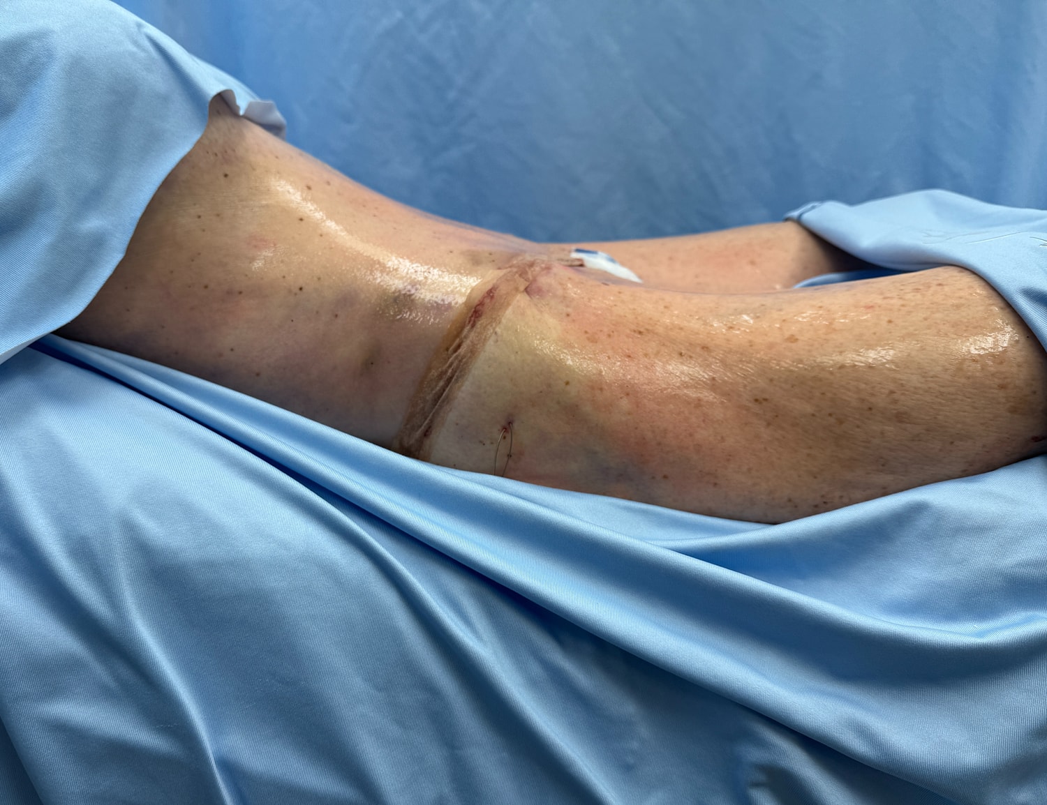 Surgical knee procedure with visible incision site.