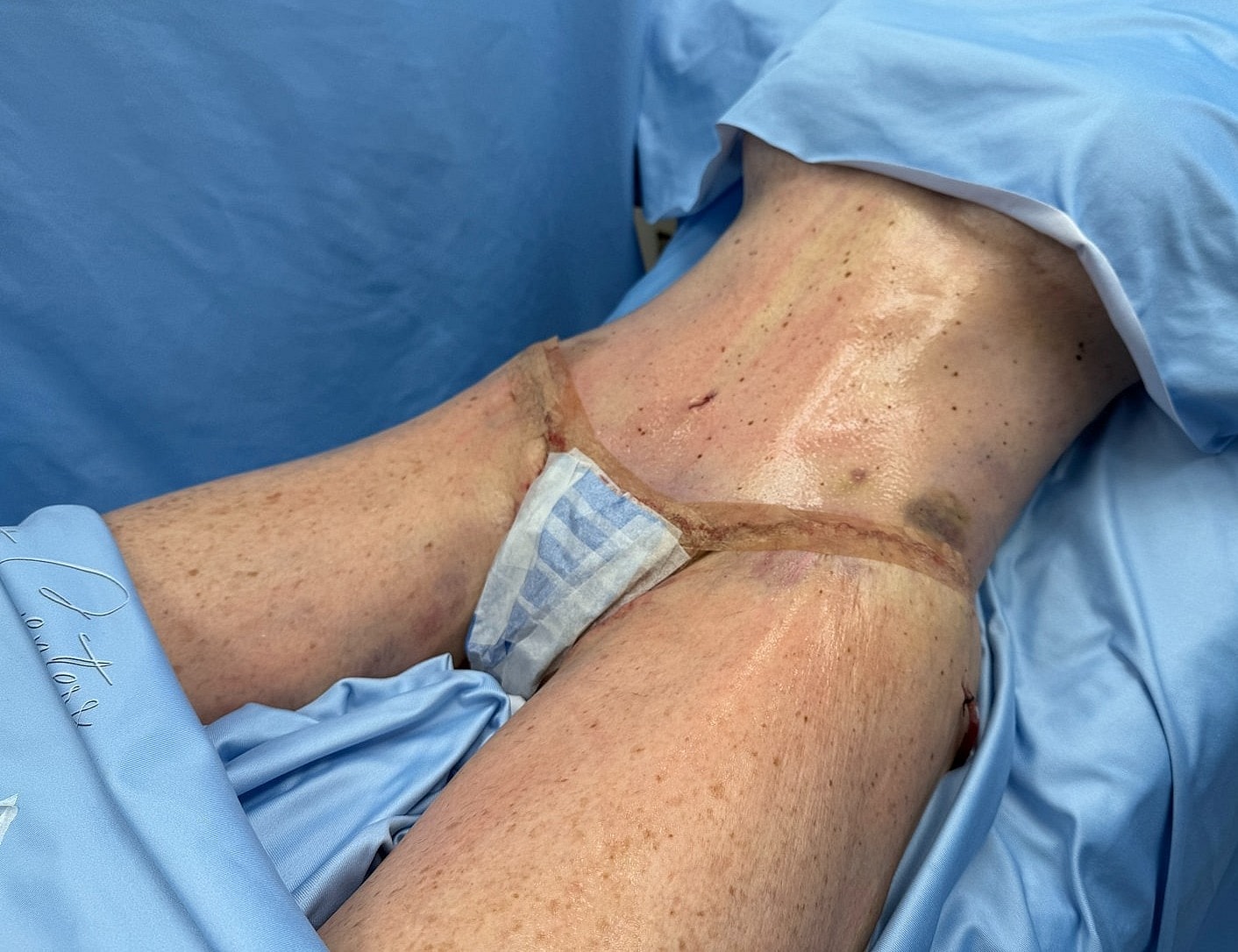 Surgical site with dressing on abdomen.