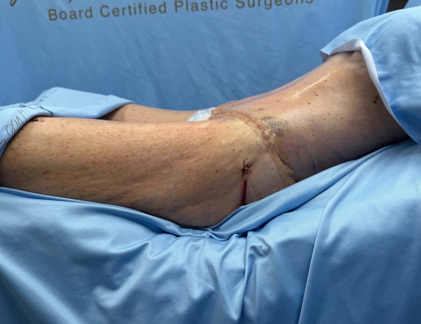 Surgical procedure on a patient's leg.