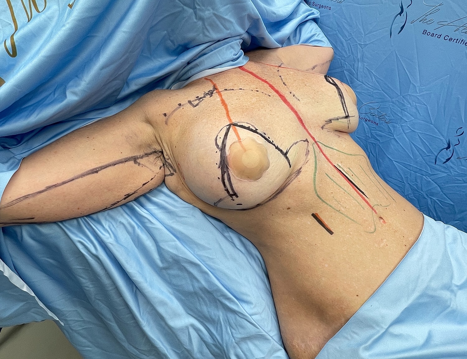 Patient prepared for body contouring procedure.