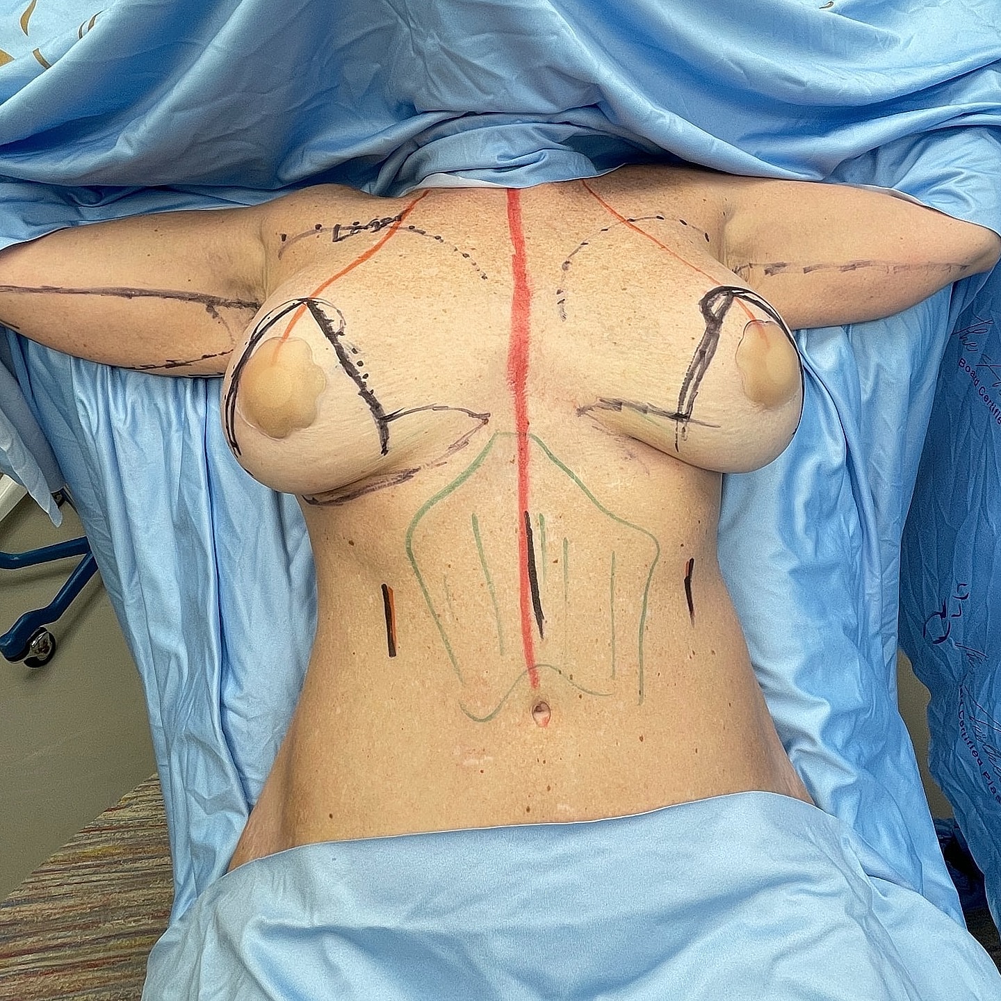 Surgical preparation for body contouring procedure.