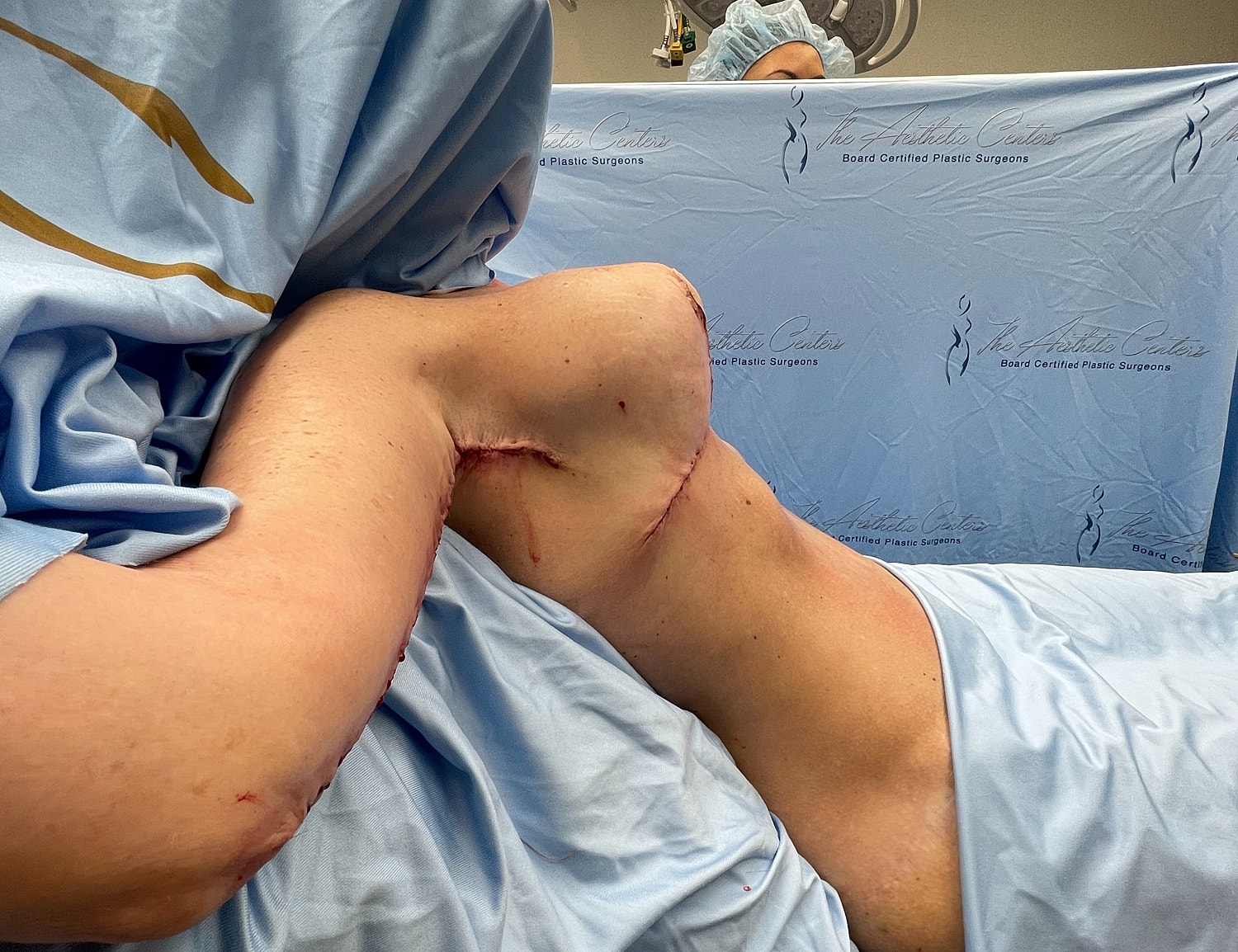 Surgical recovery of arm with visible stitches.