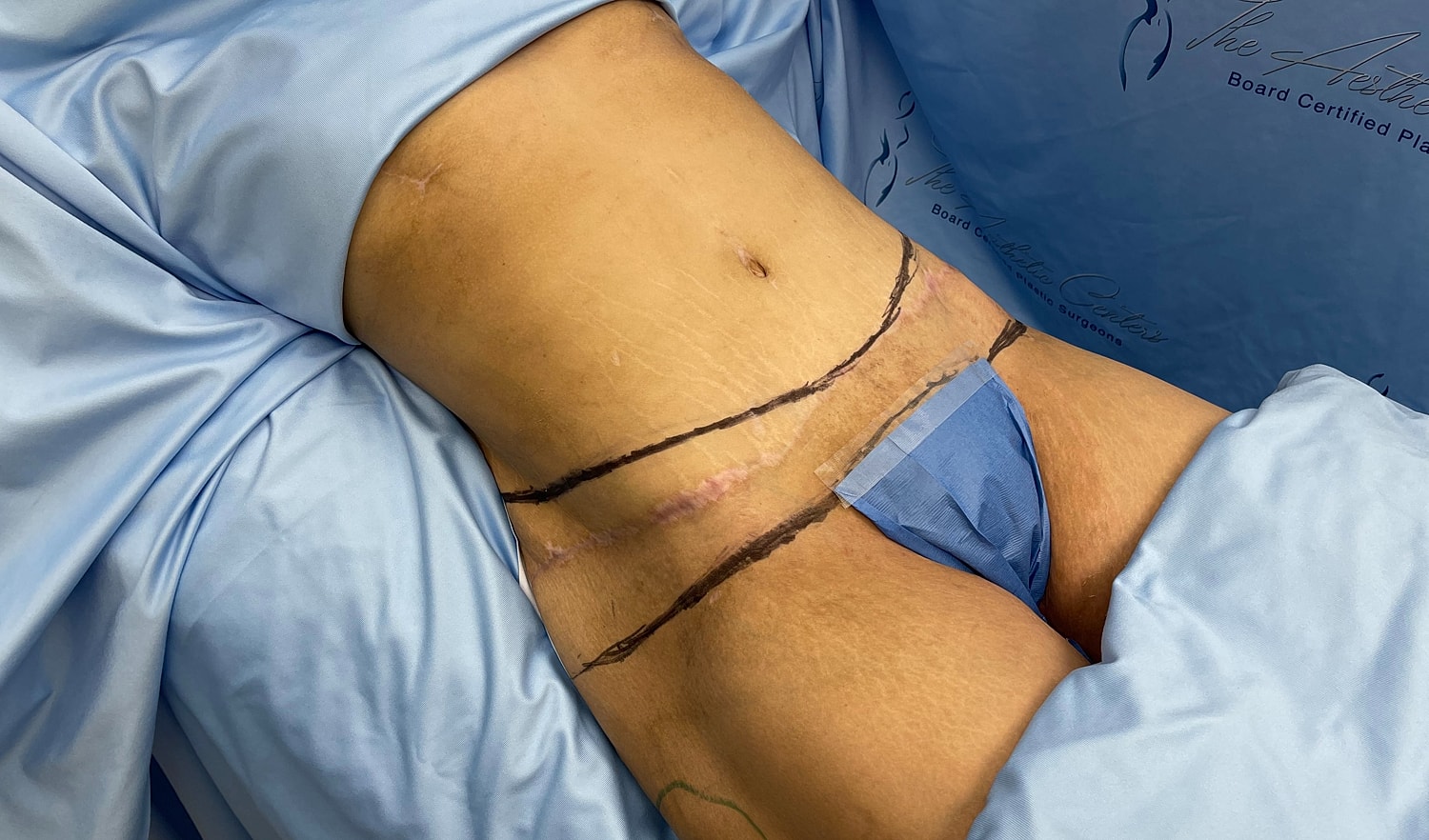 Surgical site with markings and recovery attire.