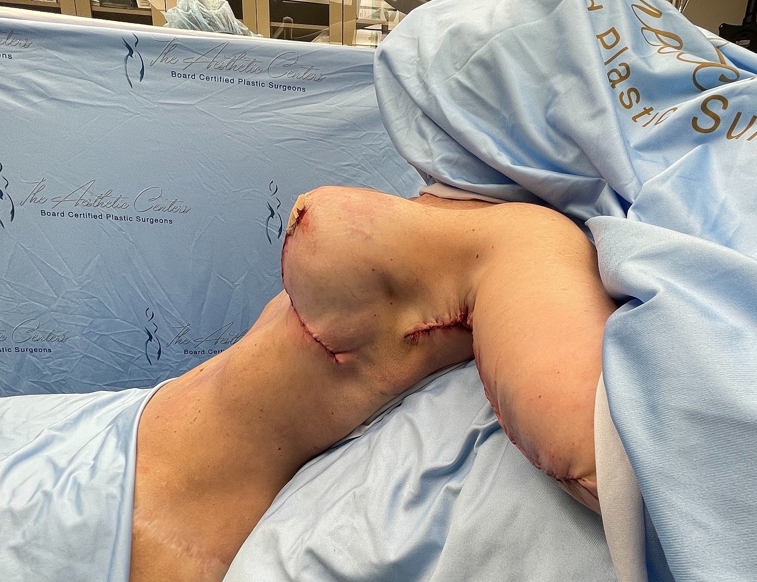 Post-surgery recovery showing stitch marks.