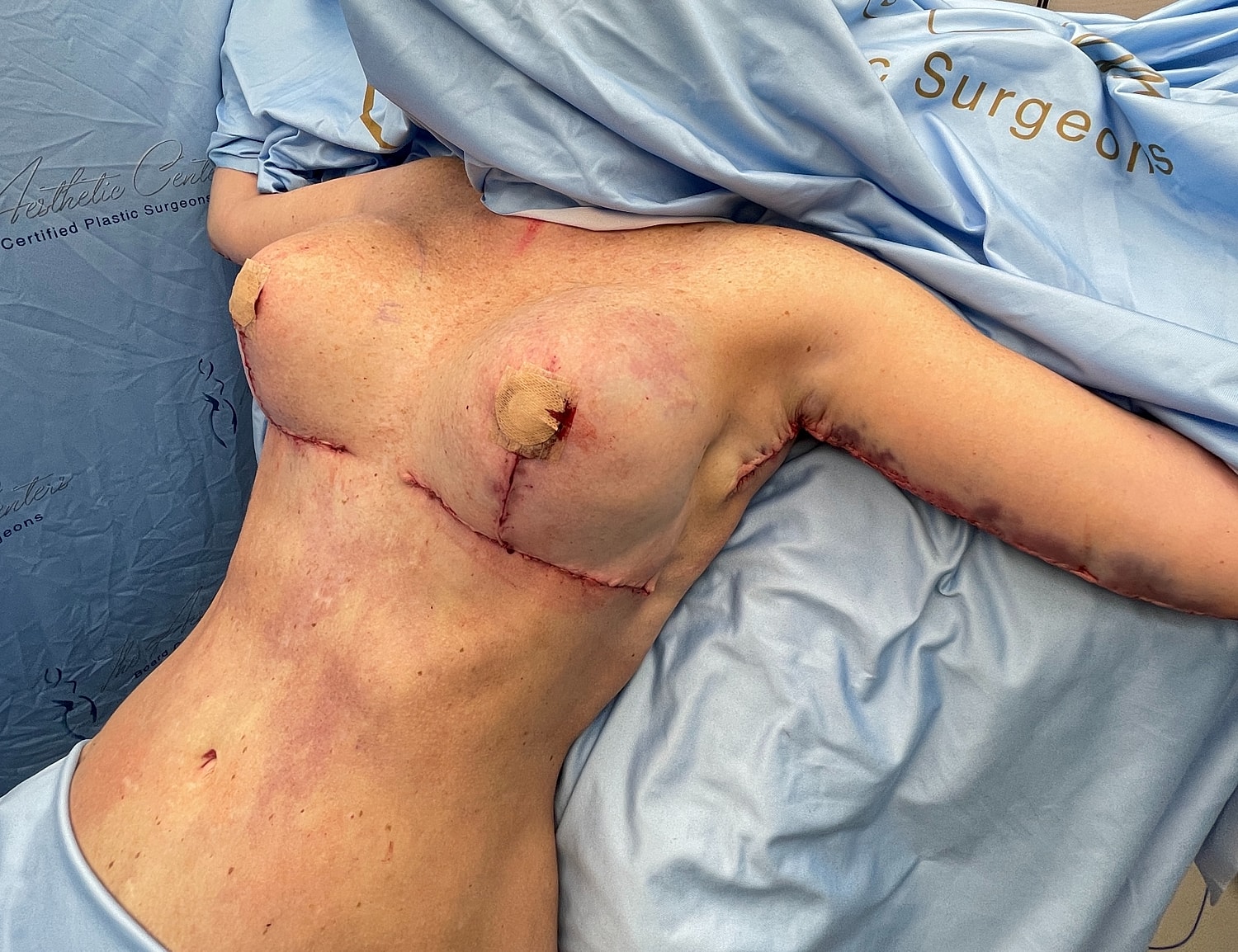 Post-surgery chest with visible scars.