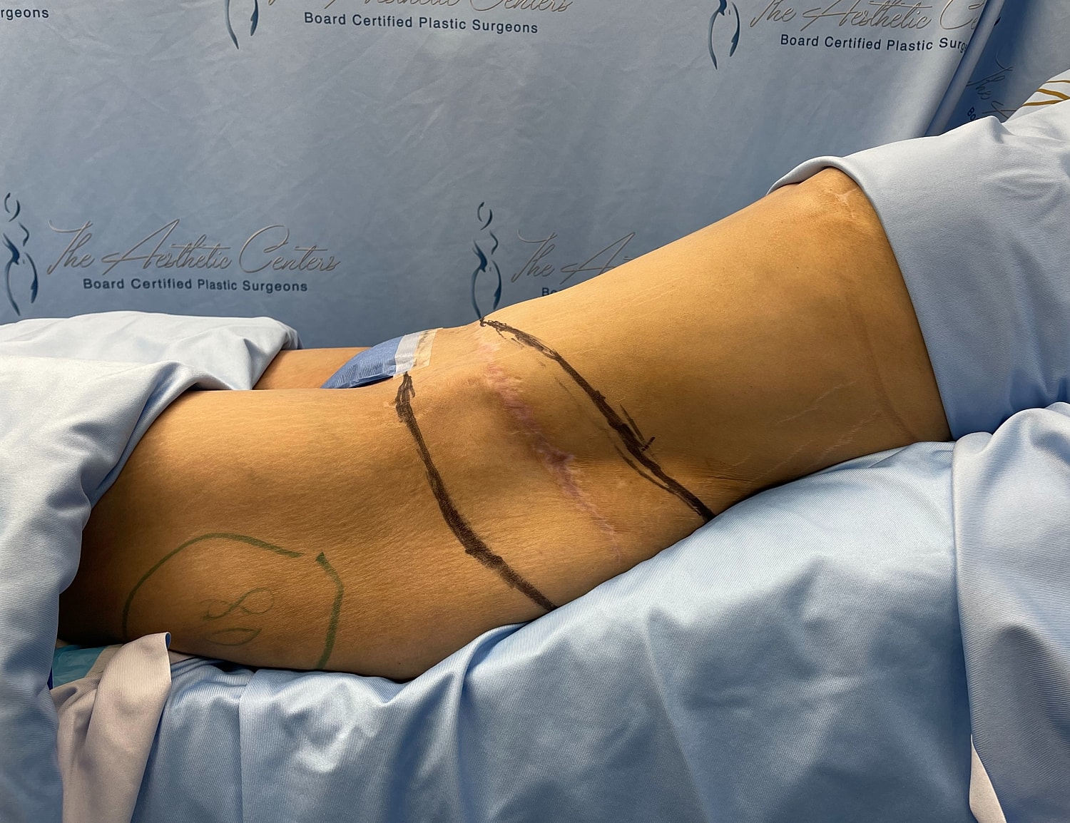 Surgical site with markings and healing scar.