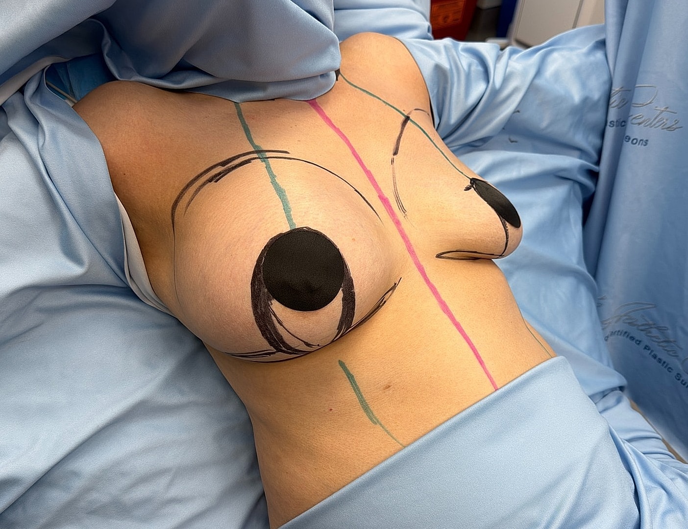 Pre-surgery markings on breast area.