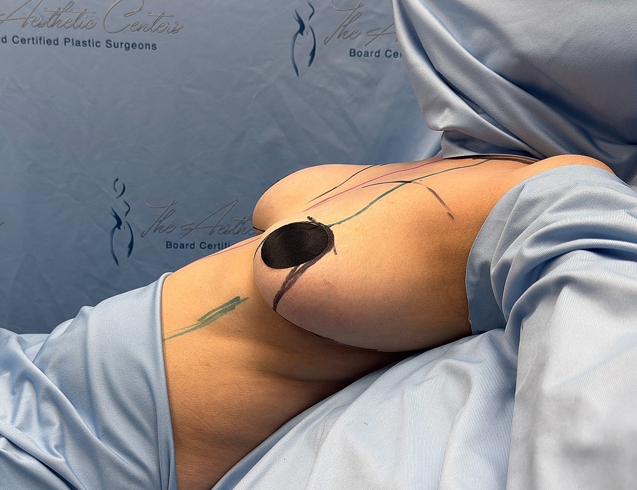Patient preparing for plastic surgery procedure.
