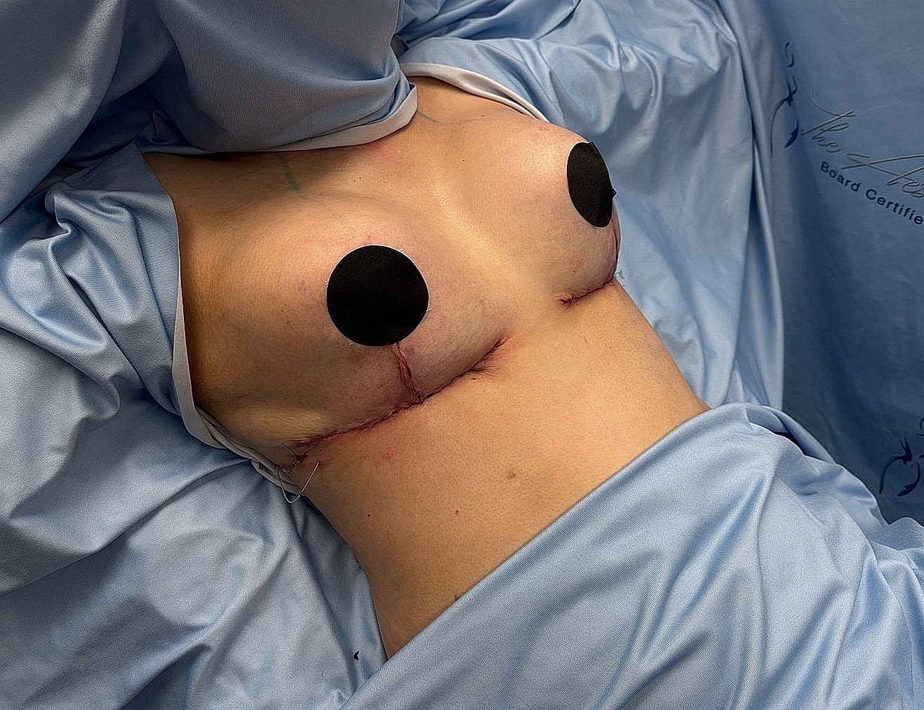 Post-surgery breast reconstruction with dressings.