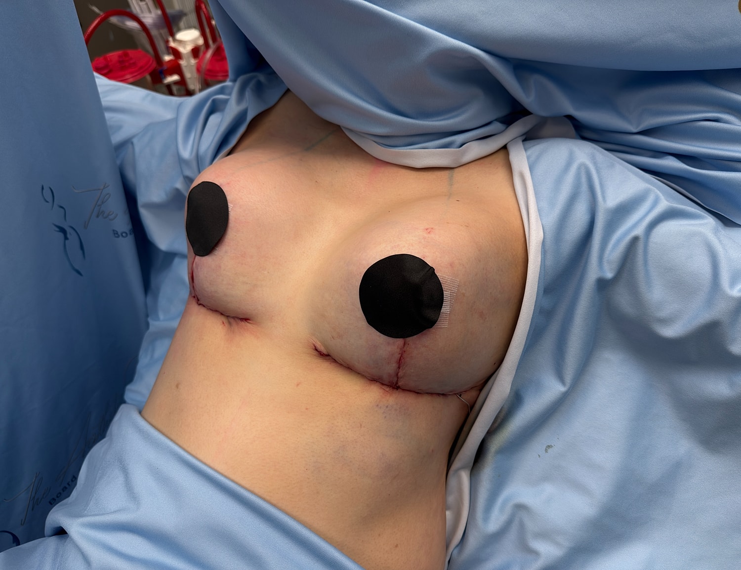 Post-surgical chest with dressings and sutures.