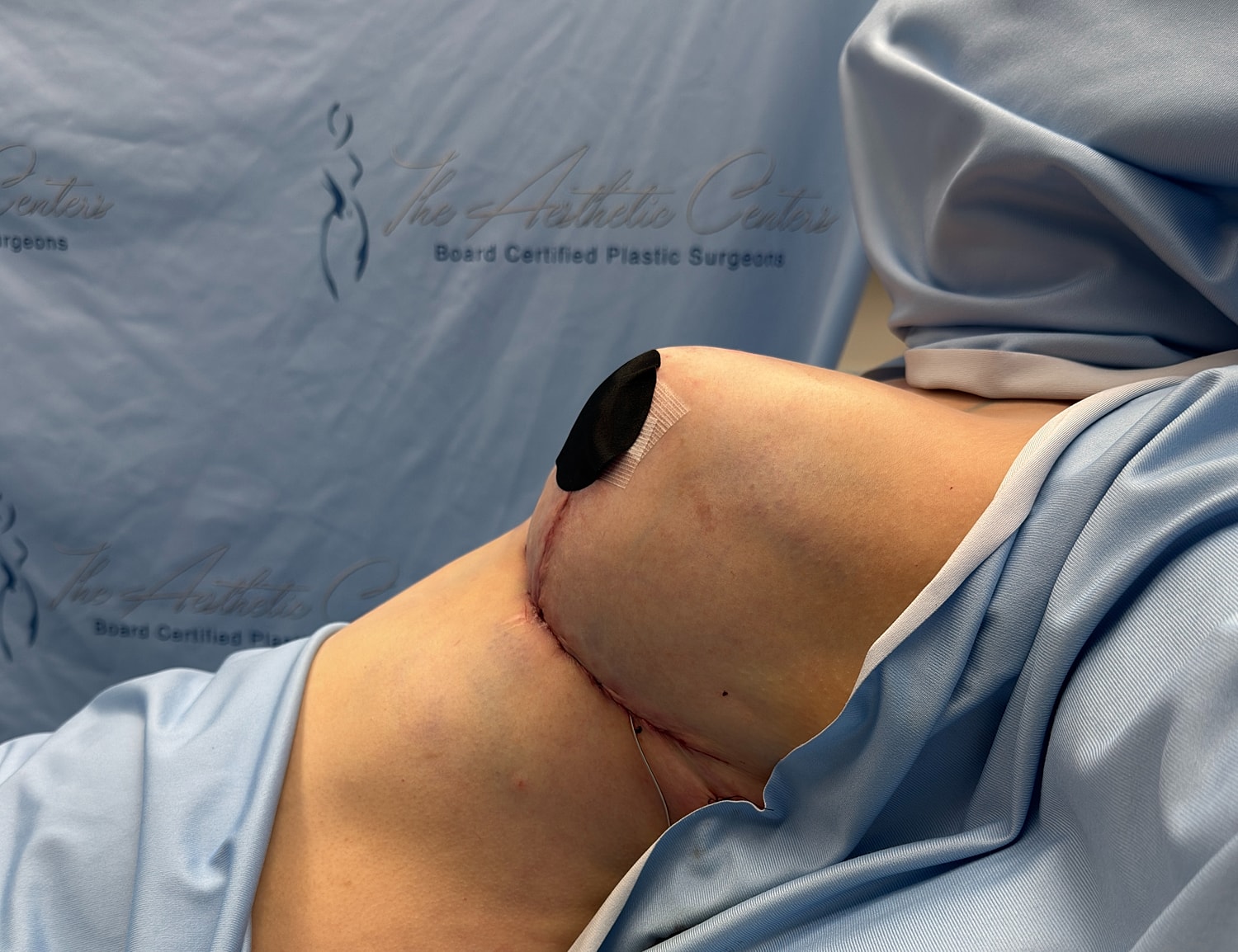 Post-surgery view of abdomen with dressings.