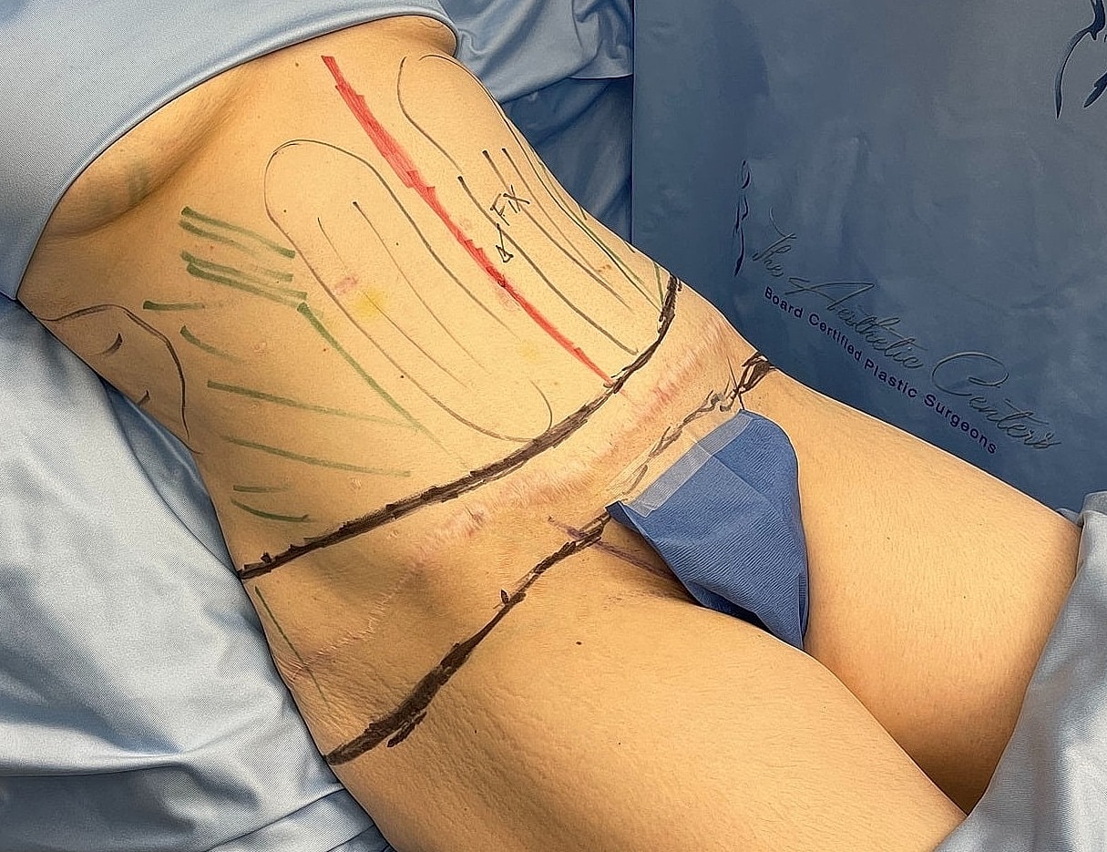 Patient preparation for surgery with marked abdomen.