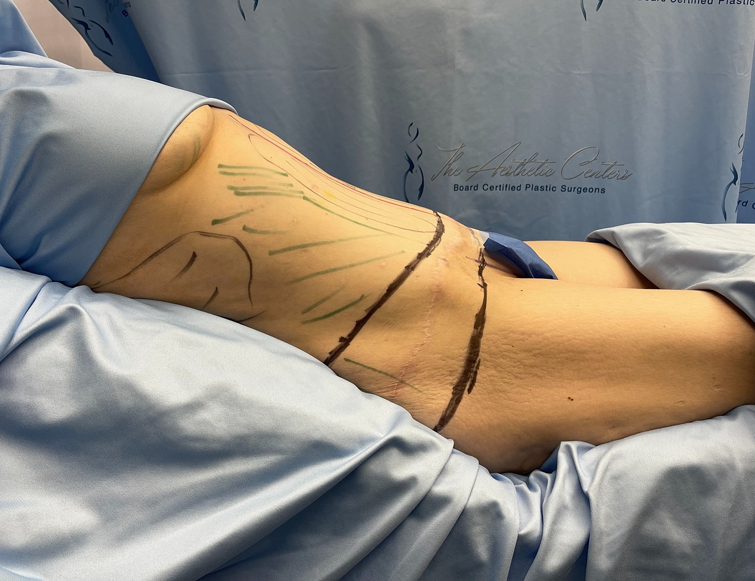 Pre-surgery markings on patient's abdomen.