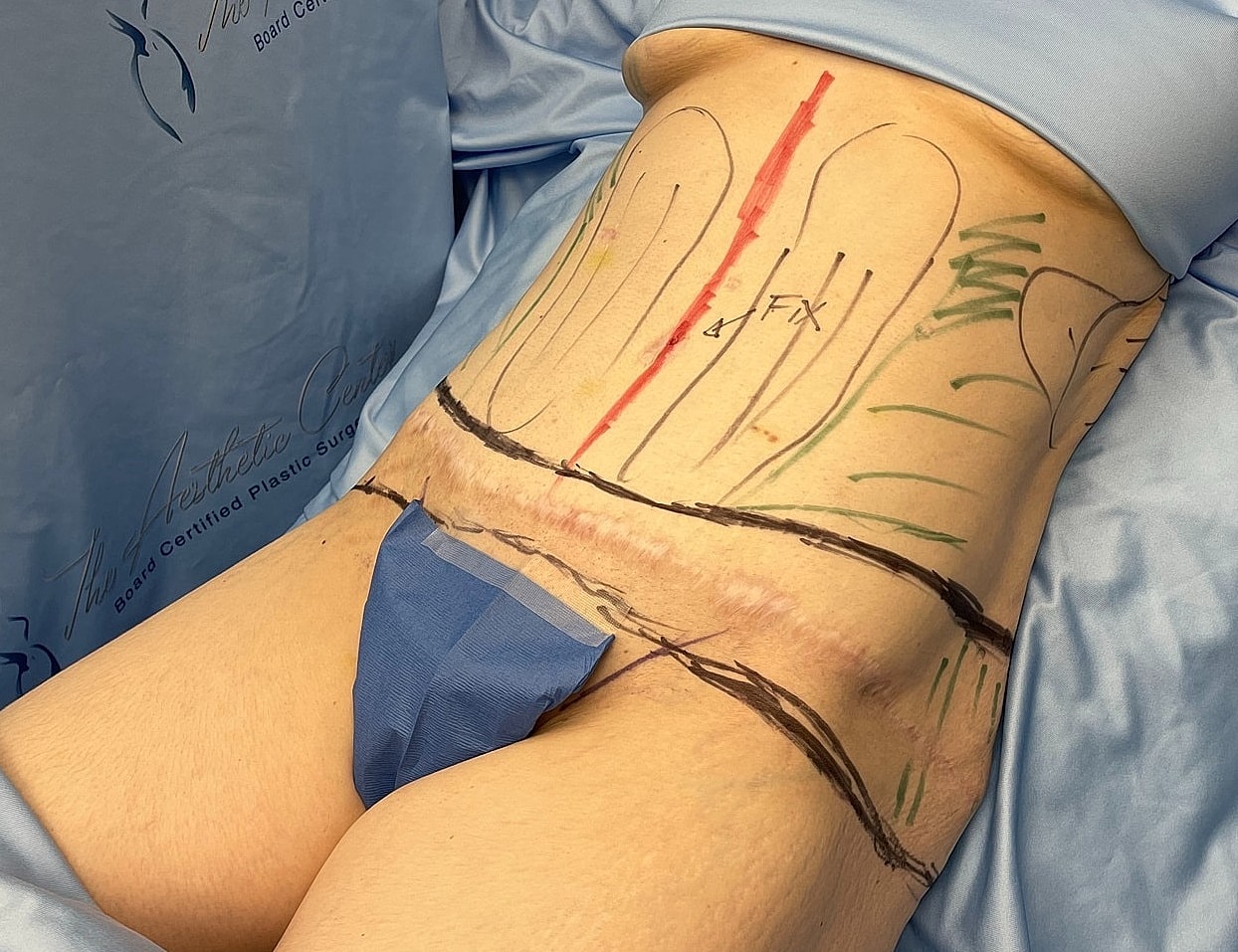Abdomen marked for surgical procedure preparation