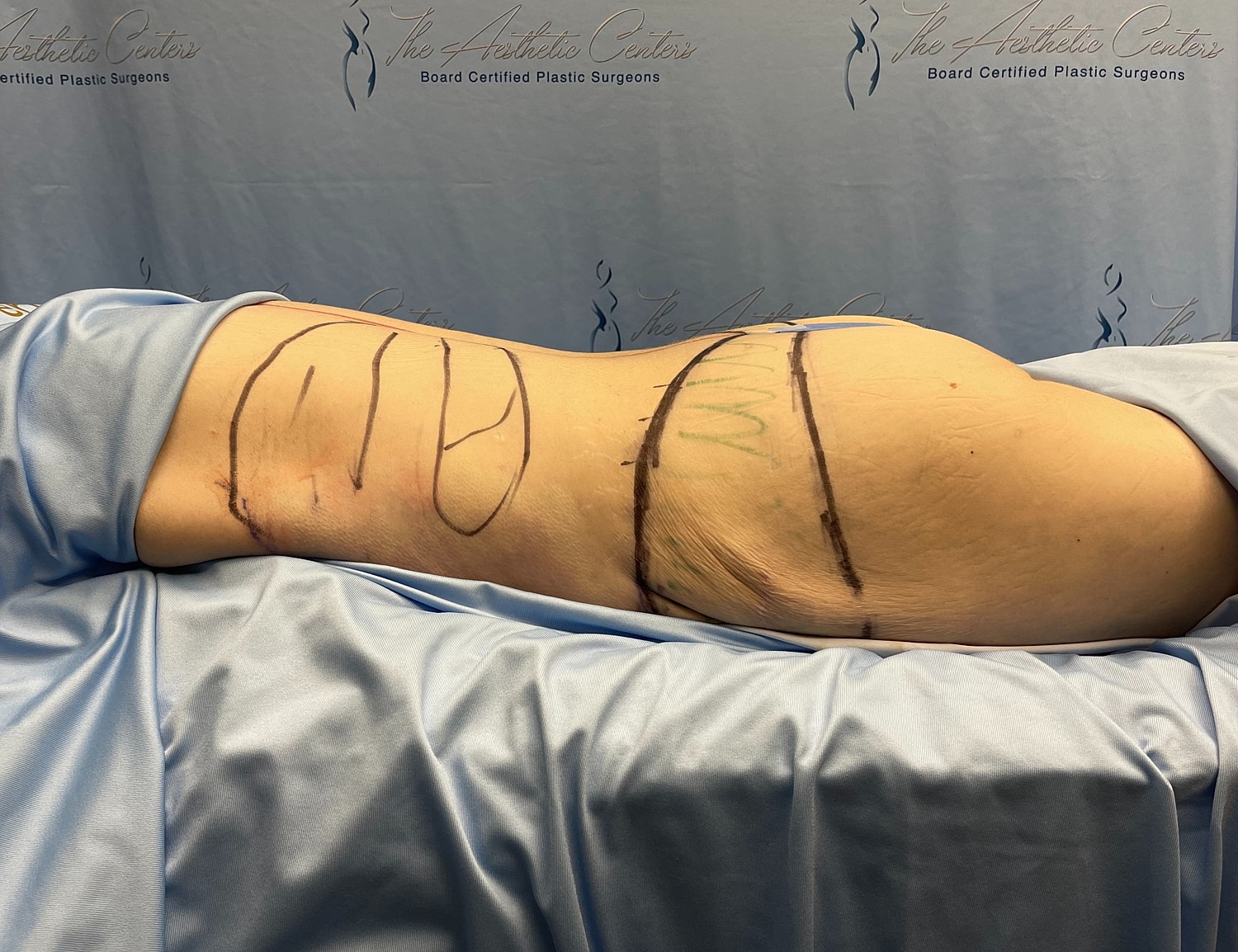 Marked body prior to a cosmetic procedure.