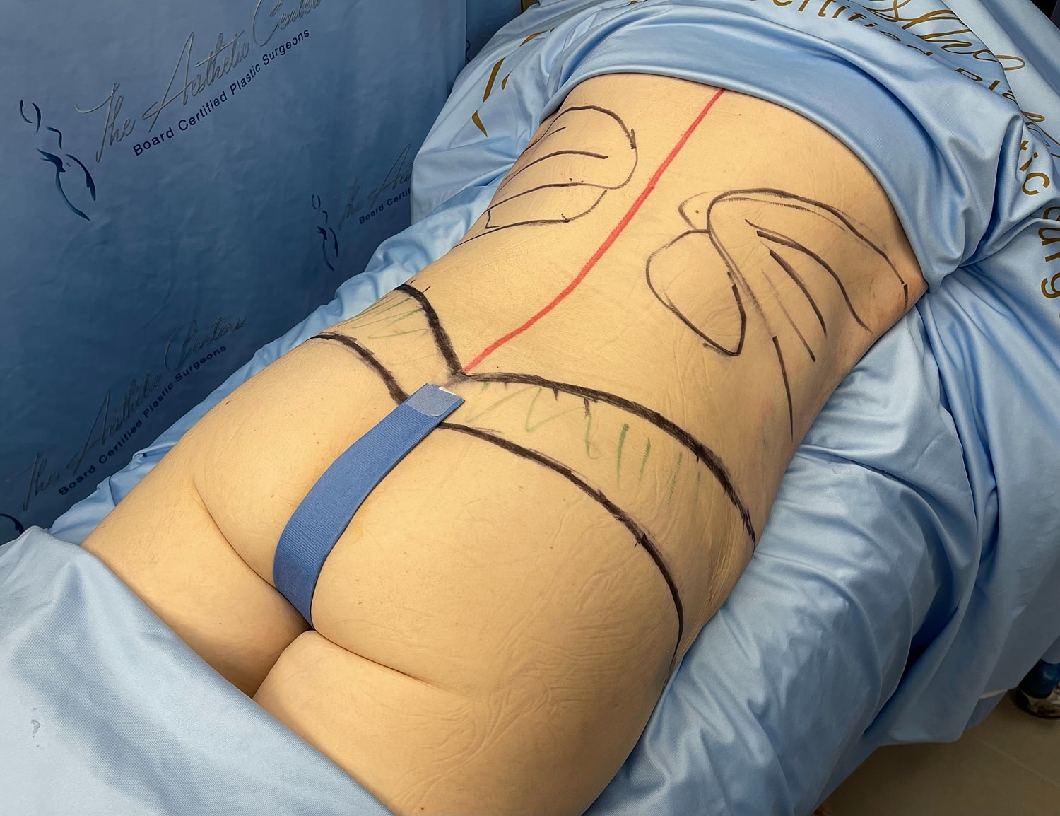 Patient's back marked for cosmetic surgery procedure.