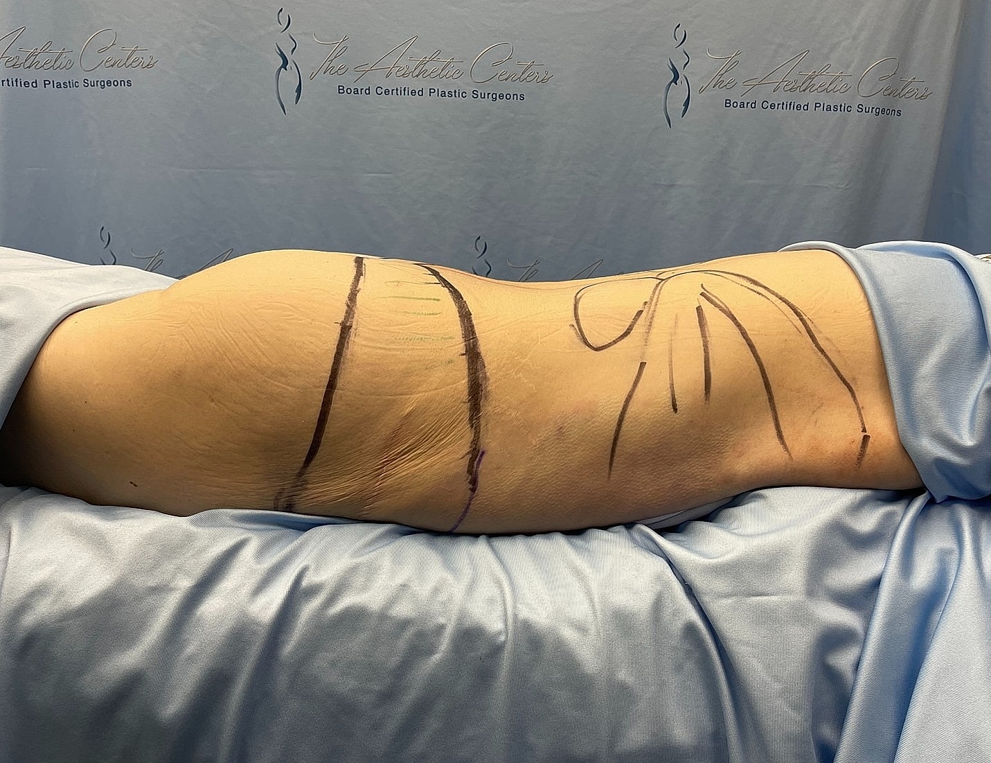 Body marking for aesthetic surgical procedure preparation