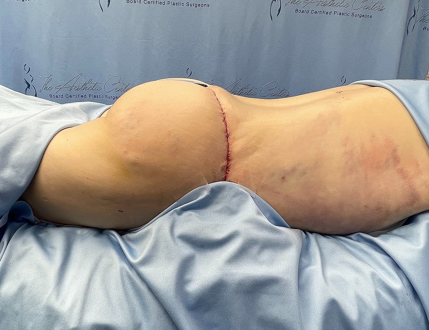 Post-surgery body with visible scarring and bruising.