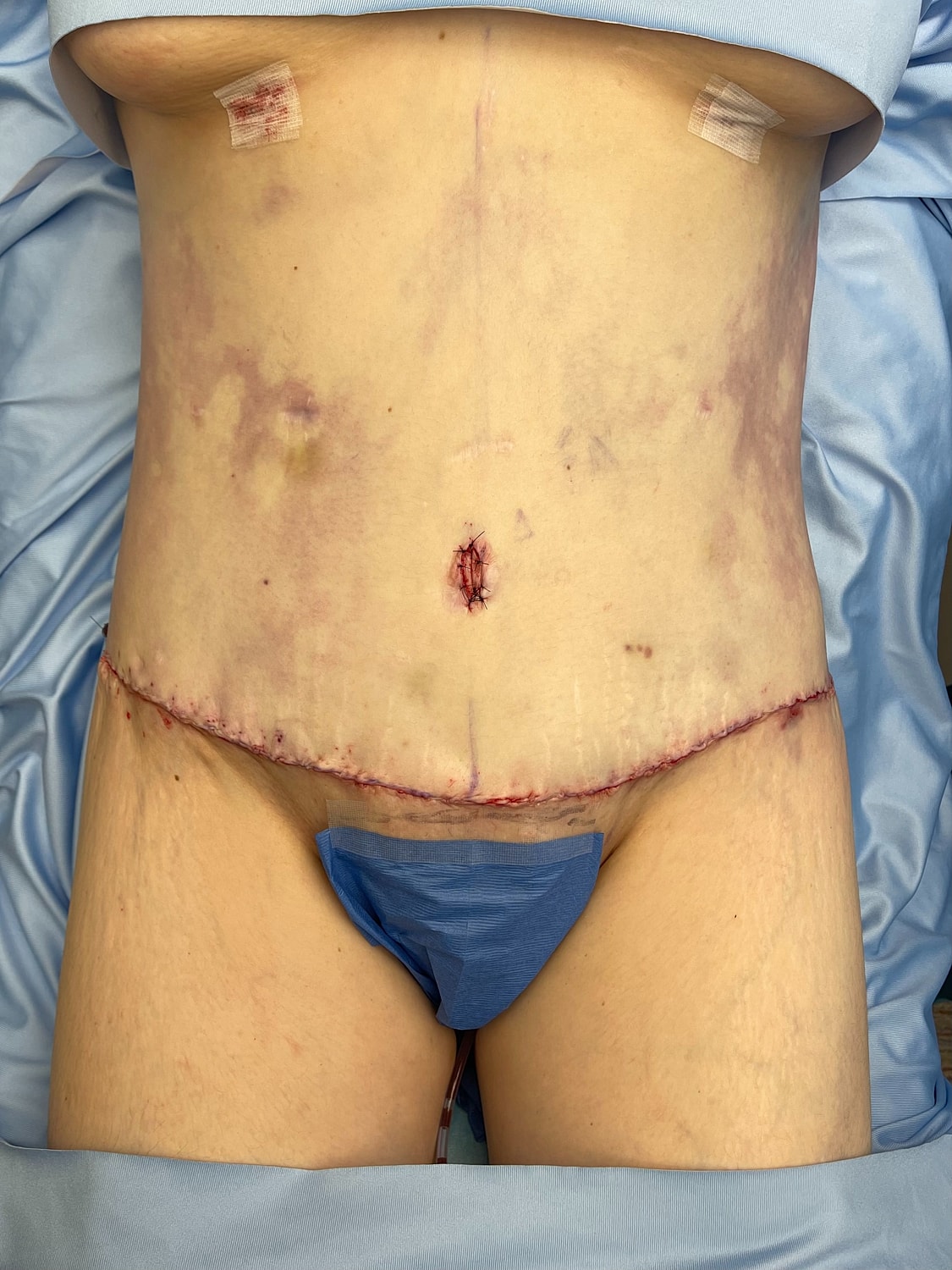 Surgical incision on a patient's abdomen.