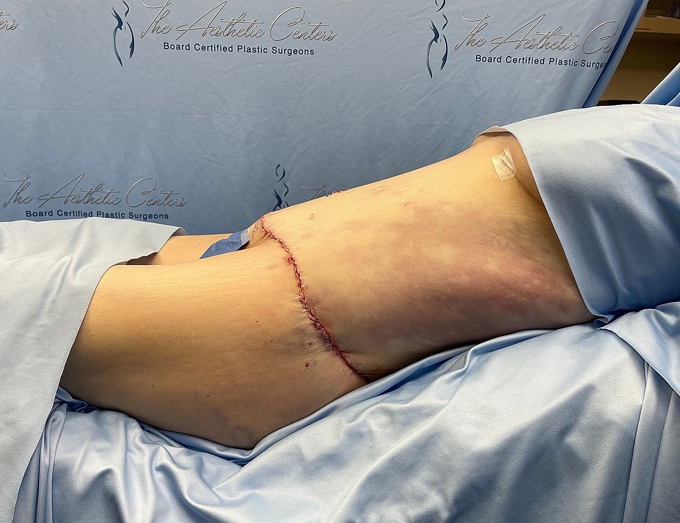 Surgical site on patient’s side after procedure.