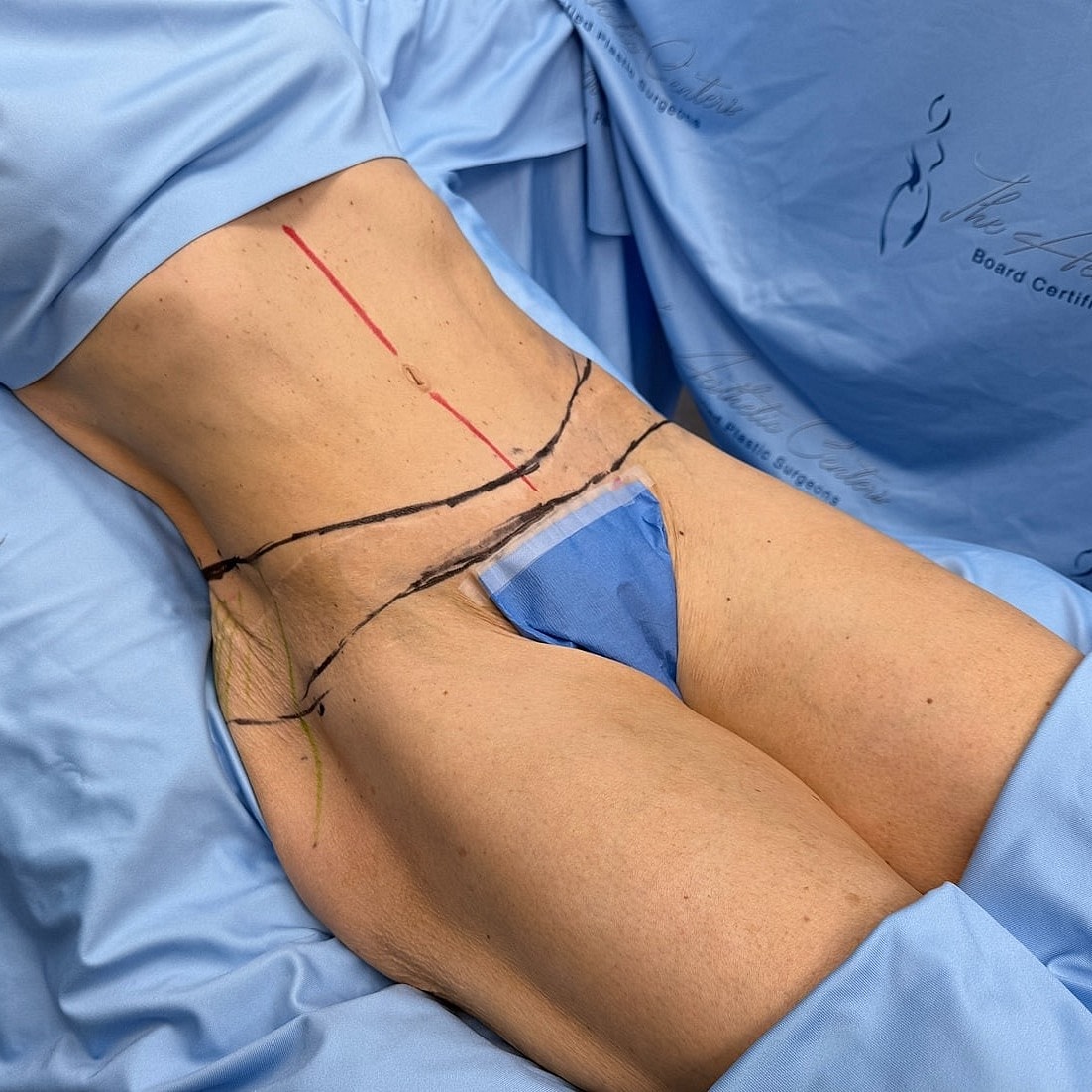 Surgical area marked for procedure preparation.