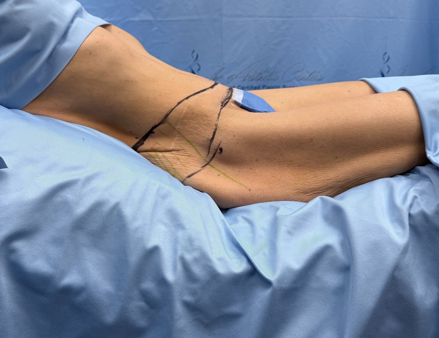 Patient preparation for a medical procedure.