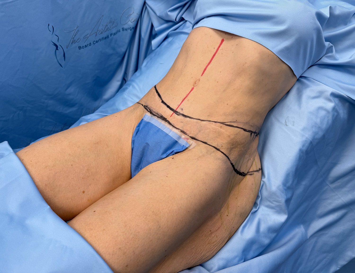 Patient prepared for undergoing surgical procedure.